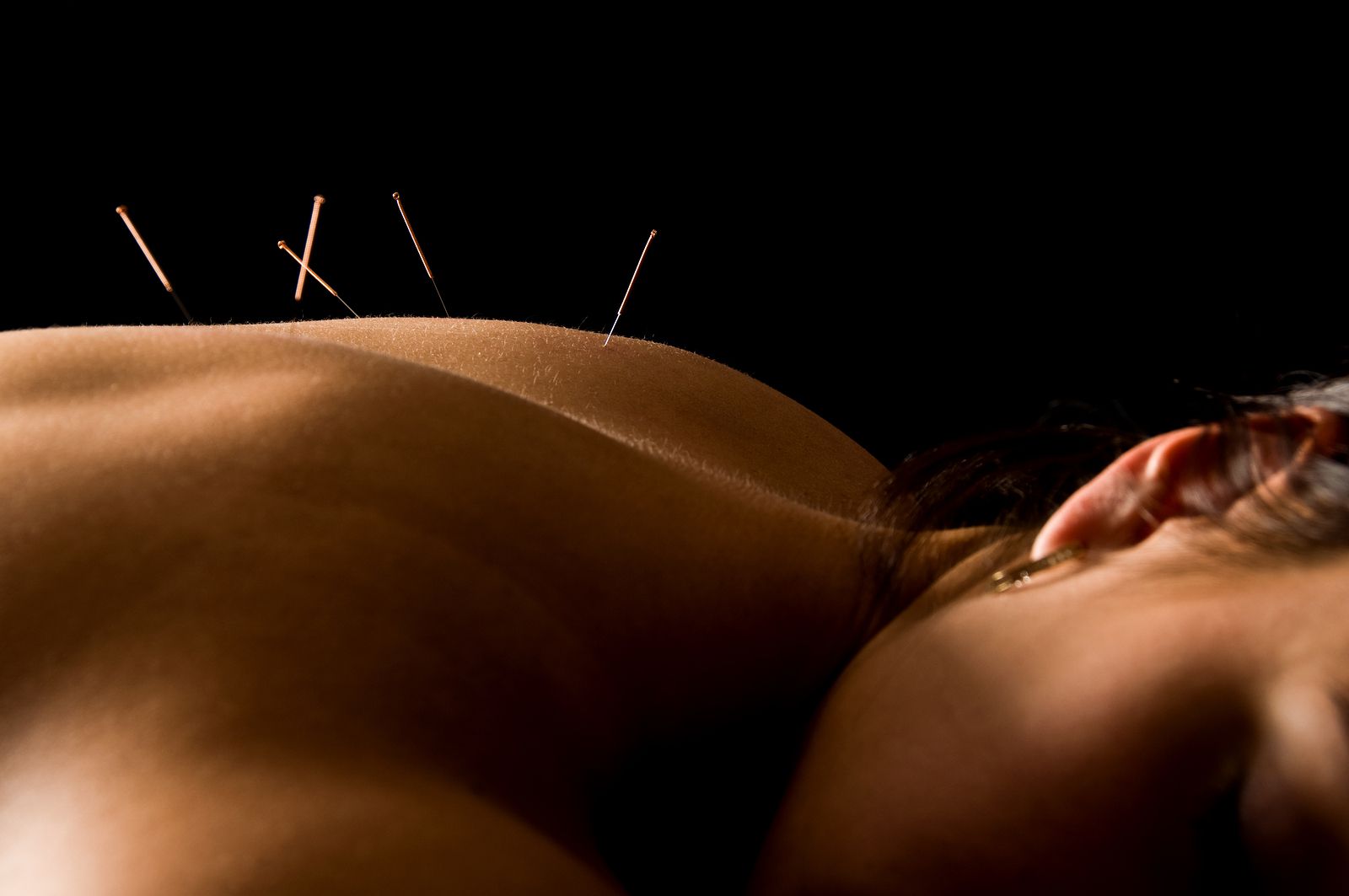 ProHealth Chiropractic & Injury Center - Acupuncture